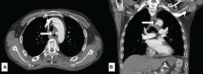 Clinical characteristics and risk factors for 30-day mortality in esophageal cancer patients with upper gastrointestinal bleeding: a multicenter study